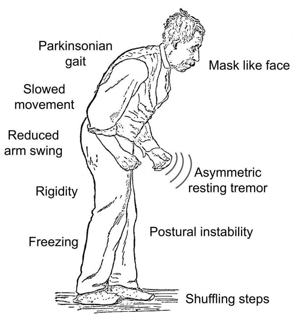 Parkinson s Disease Quiz Symptoms Early Signs of Parkinson s