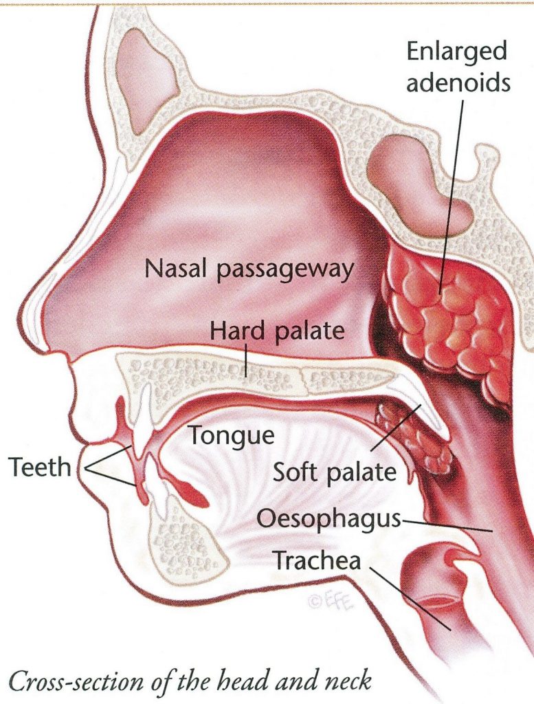 Pediatric Adenoidectomy Procedure Risks Recovery