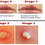 Pimple vs Cold Sore Pictures Differences Similarities