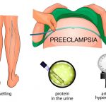 Preeclampsia vs Eclampsia Symptoms Causes Treatment