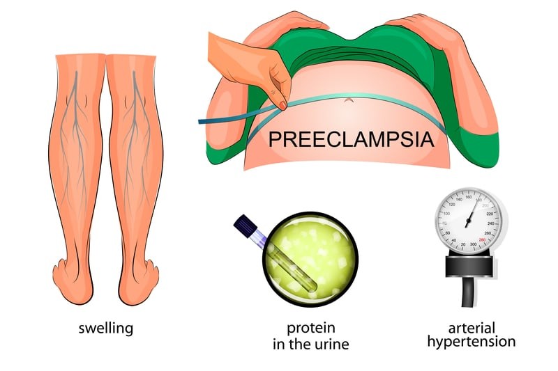 Preeclampsia vs Eclampsia Symptoms Causes Treatment