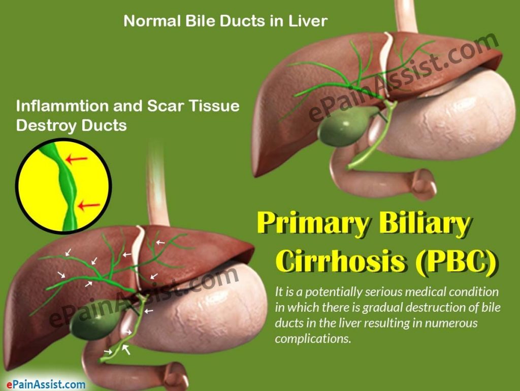 Primary Biliary Cirrhosis Life Expectancy Symptoms Treatment