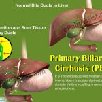 Primary Biliary Cirrhosis Life Expectancy Symptoms Treatment