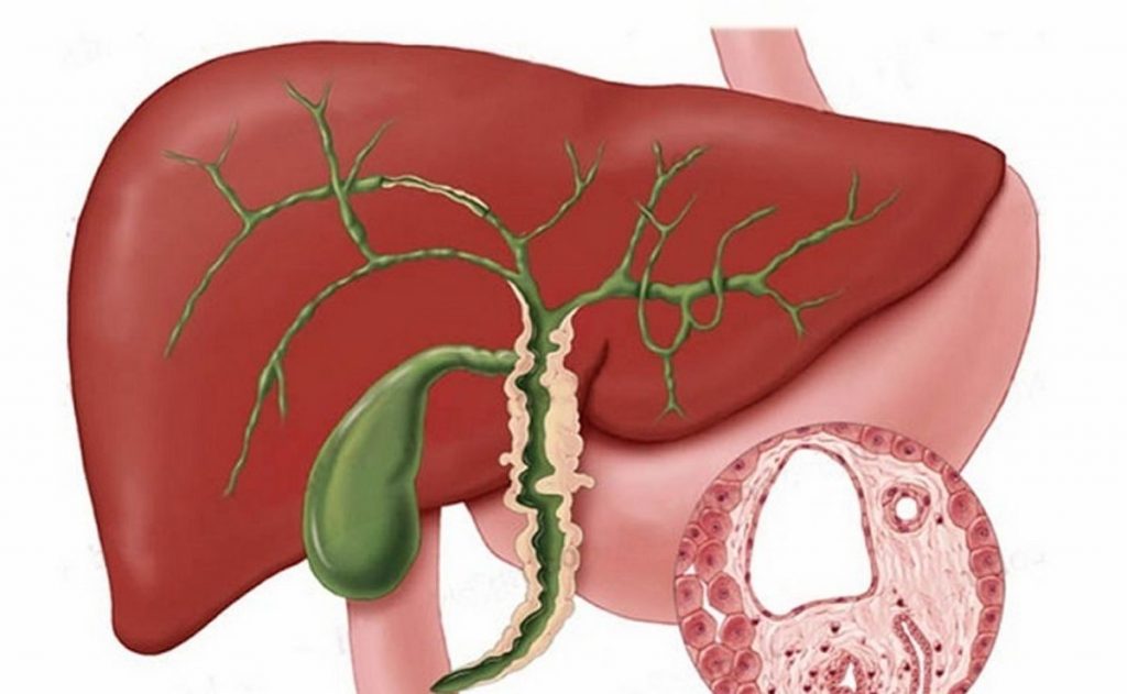 Primary Sclerosing Cholangitis Symptoms Treatment Prognosis