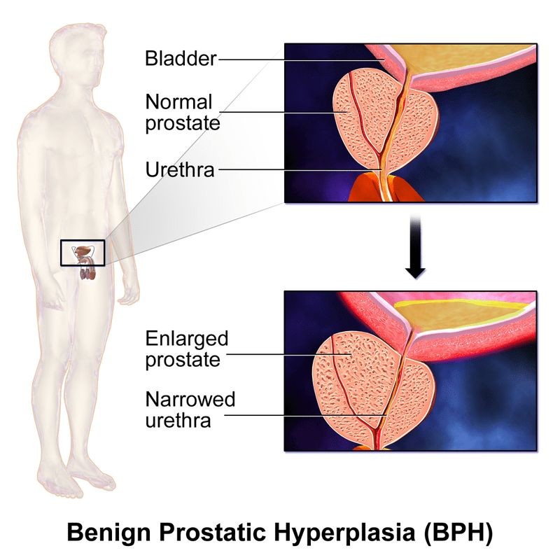 Prostatitis vs BPH Enlarged Prostate Symptoms Differences Causes