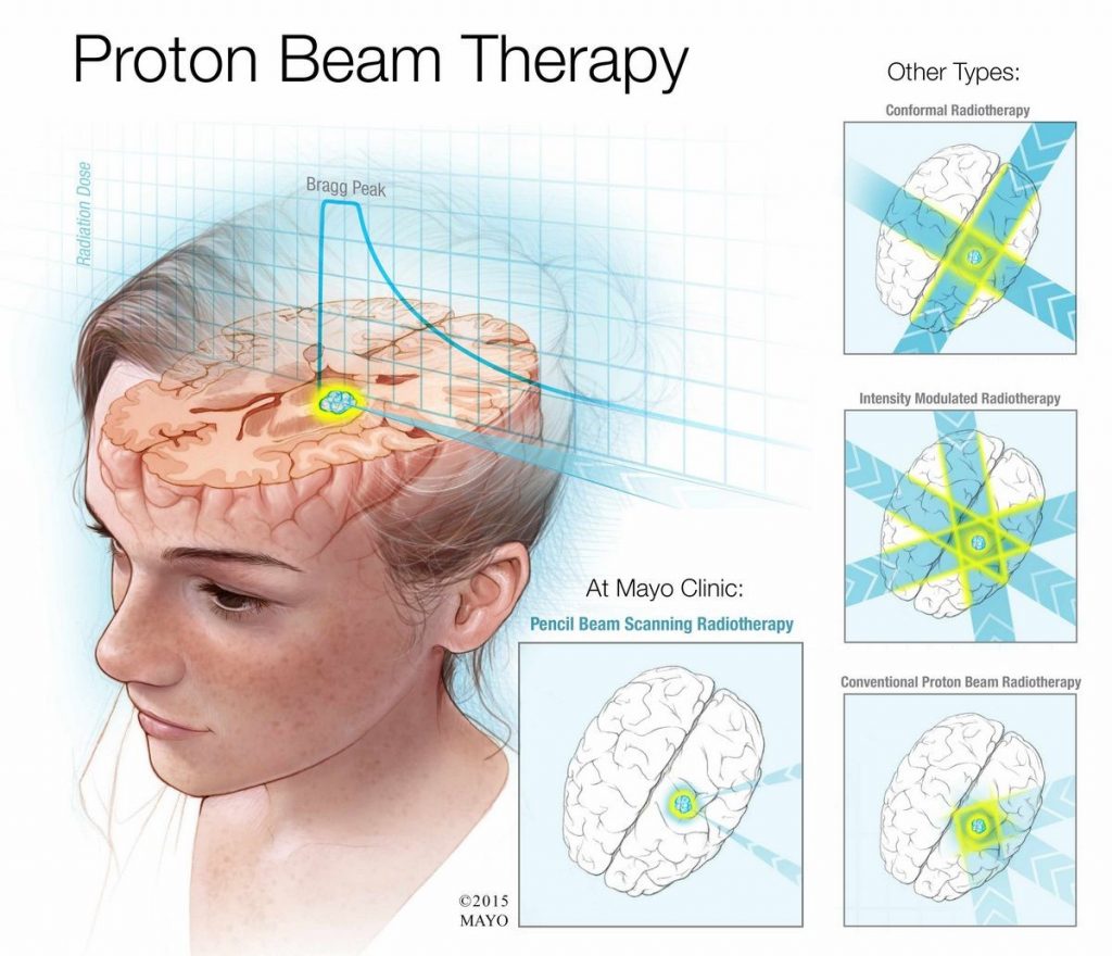 Proton Beam Therapy of the Liver Procedure Side Effects