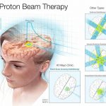 Proton Beam Therapy of the Liver Procedure Side Effects