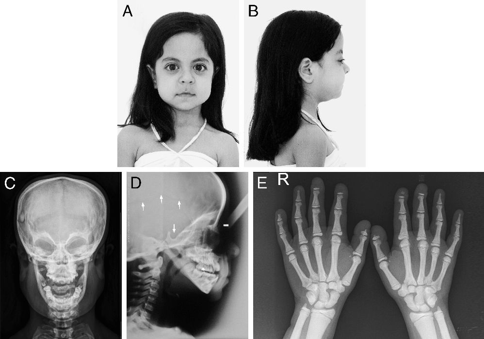 Pycnodysostosis Get Facts About Symptoms Treatment