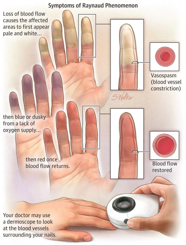 Raynaud s Phenomenon Disease Causes Symptoms Treatment Medications Prevention