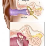 Ruptured Eardrum Symptoms Healing Time Ear Drops Treatment