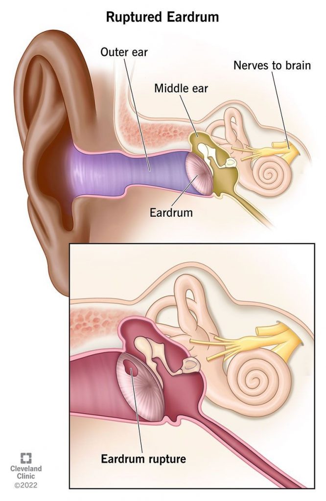 Ruptured Eardrum Symptoms Healing Time Ear Drops Treatment