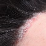 Scalp Psoriasis Pictures Treatment Causes Symptoms Shampoo