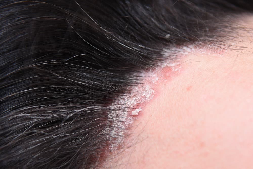 Scalp Psoriasis Pictures Treatment Causes Symptoms Shampoo