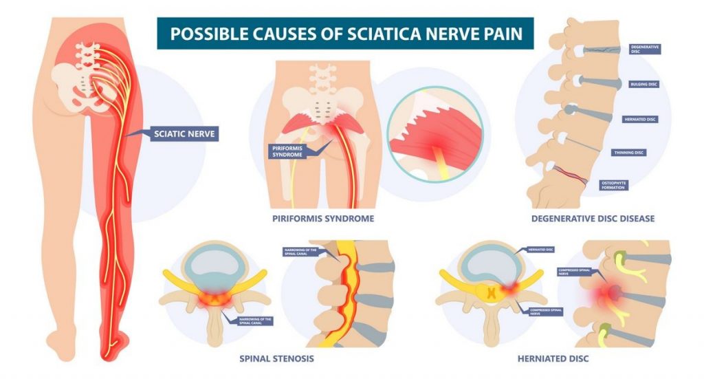 Sciatica Causes Symptoms Treatment Medications Prevention