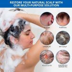 Seborrheic Dermatitis Pictures Causes Shampoo Treatment