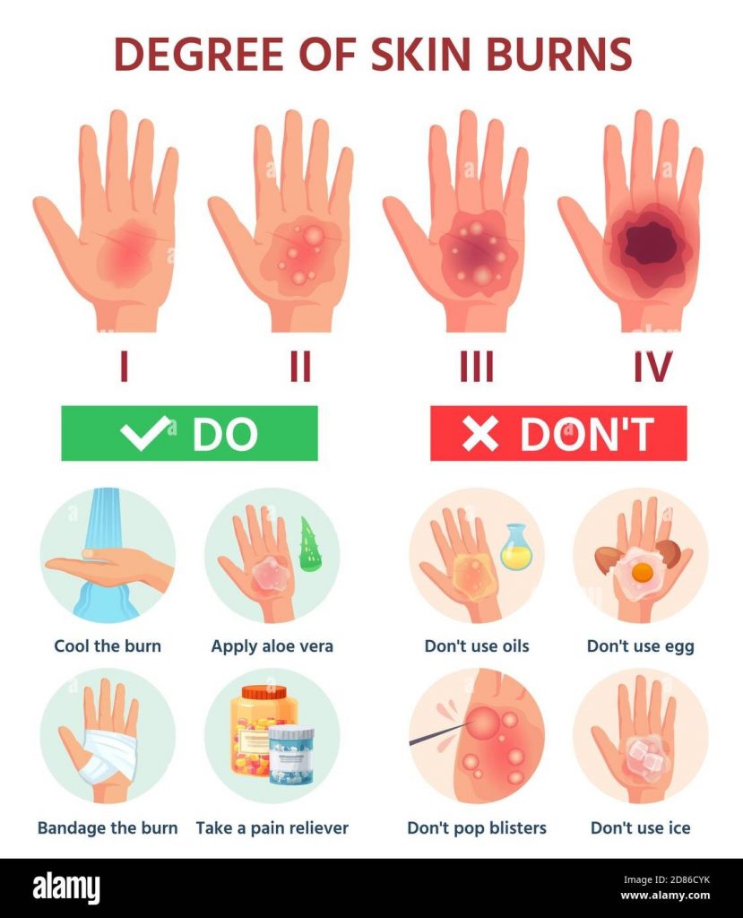 Should You Cover a Burn or Let It Breathe Treatment Types Causes