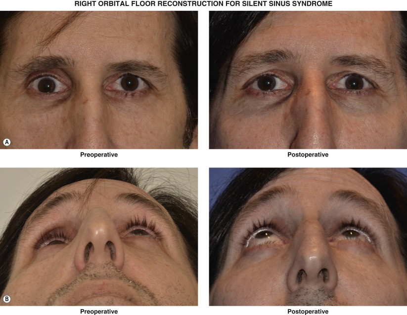 Silent Sinus Syndrome Causes Symptoms Diagnosis Treatment