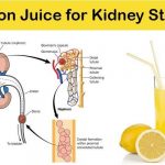 Sodium Citrate Kidney Stone Uses Side Effects Dosage