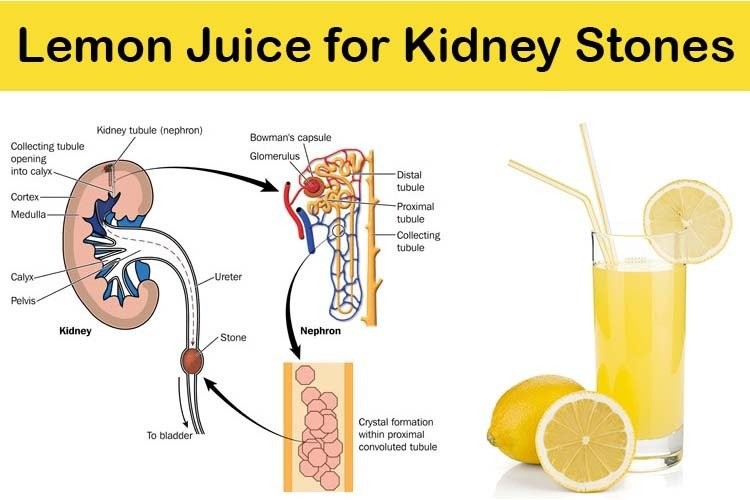 Sodium Citrate Kidney Stone Uses Side Effects Dosage