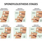 Spondylolisthesis Symptoms Treatment Surgery