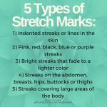 Stretch Marks Types Causes Risk Factors Symptoms Treatment