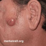 Survival Rate for Merkel Cell Carcinoma Stages of MCC