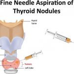 Thyroid Fine-Needle Aspiration Biopsy Side Effects Results