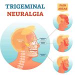 Trigeminal Neuralgia Treatment Causes Symptoms 12 Cranial Nerves