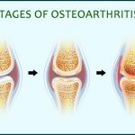 Types of Osteoarthritis Medications and Treatments