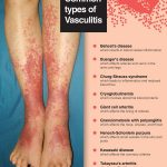 Vasculitis Types Causes Symptoms Diagnosis Treatment