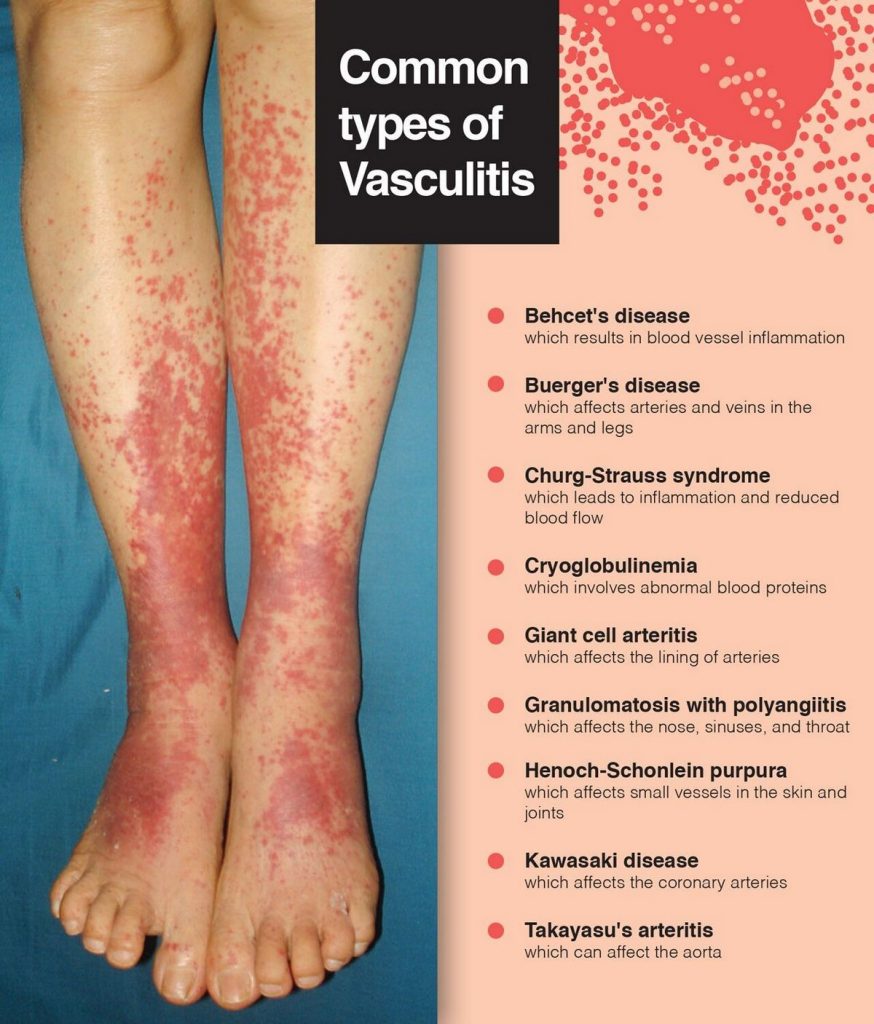 Vasculitis Types Causes Symptoms Diagnosis Treatment