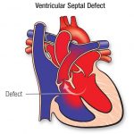 Ventricular Septal Defect VSD Types Symptoms Treatment