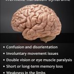 Wernicke-Korsakoff Syndrome Symptoms Causes Diagnosis Treatment