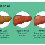 What Are the 4 Stages of Cirrhosis of the Liver