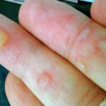 What Are the Causes of Blisters on the Hands