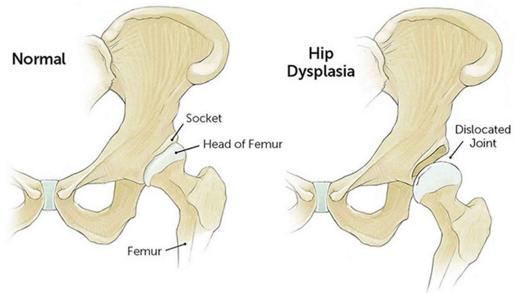 What Are the Signs of Hip Dysplasia in Babies and Adults Treatment