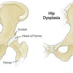 What Are the Signs of Hip Dysplasia in Babies and Adults Treatment