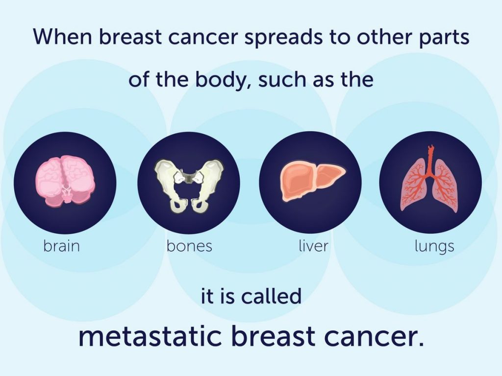 What Are the Signs of Metastatic Breast Cancer