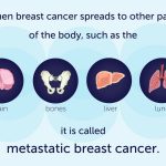 What Are the Signs of Metastatic Breast Cancer