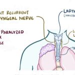 What Are the Symptoms of a Pancoast Tumor Cancer Stages