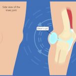 What Can Cause Pain Behind the Knee