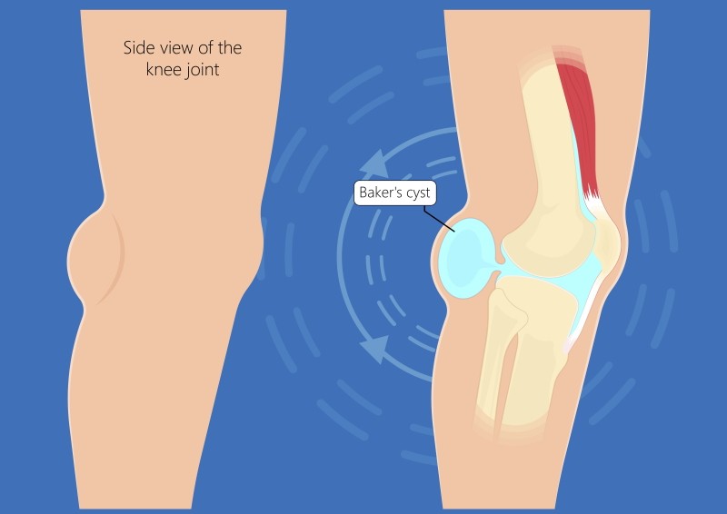 What Can Cause Pain Behind the Knee