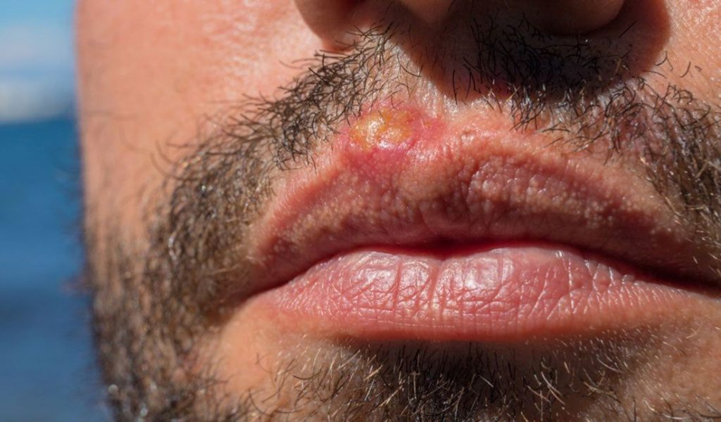 What Causes Blisters on Lips