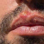 What Causes Blisters on Lips