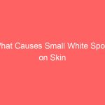 What Causes Small White Spots on Skin