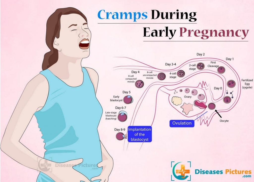 What Does Early Pregnancy Cramping Feel Like