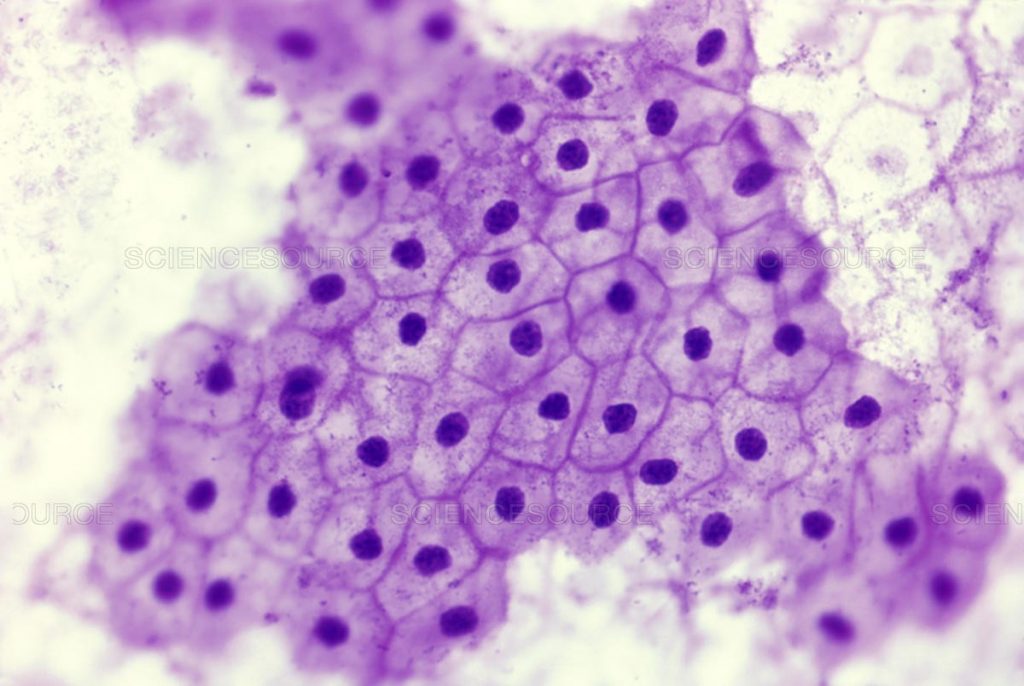 What Does It Mean to Have Squamous Epithelial Cells in Urine Normal High Ranges