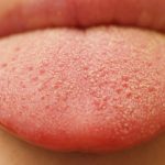 What Does It Mean When You Have Bumps on the Back of Your Tongue