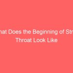 What Does the Beginning of Strep Throat Look Like Infection Symptoms