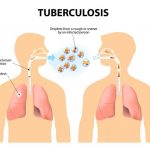 What Does Tuberculosis Do to the Body TB Symptoms Causes